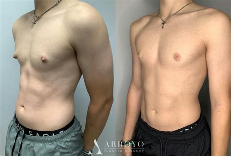 gynecomastia surgery men.